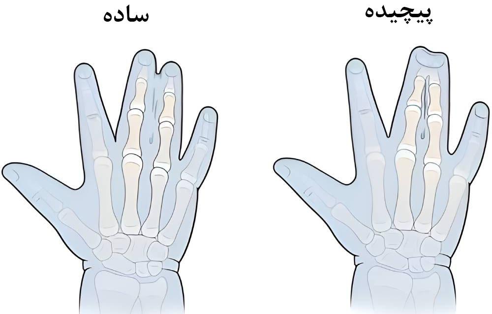 انواع سینداکتیلی
