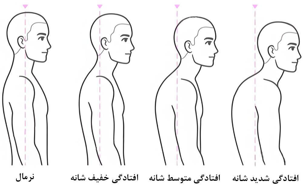 درجات افتادگی شانه