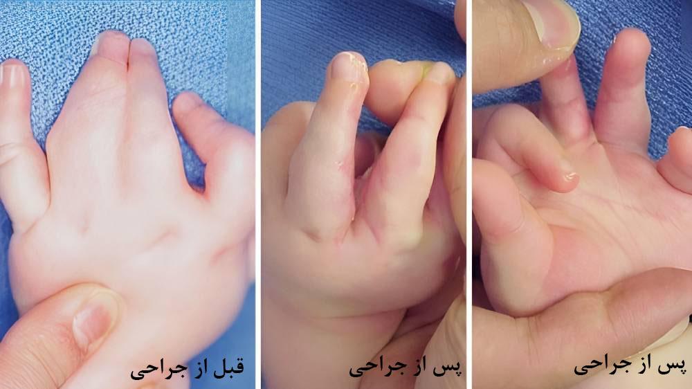 مراقبت های پس از جراحی چسبندگی انگشت در کودکان