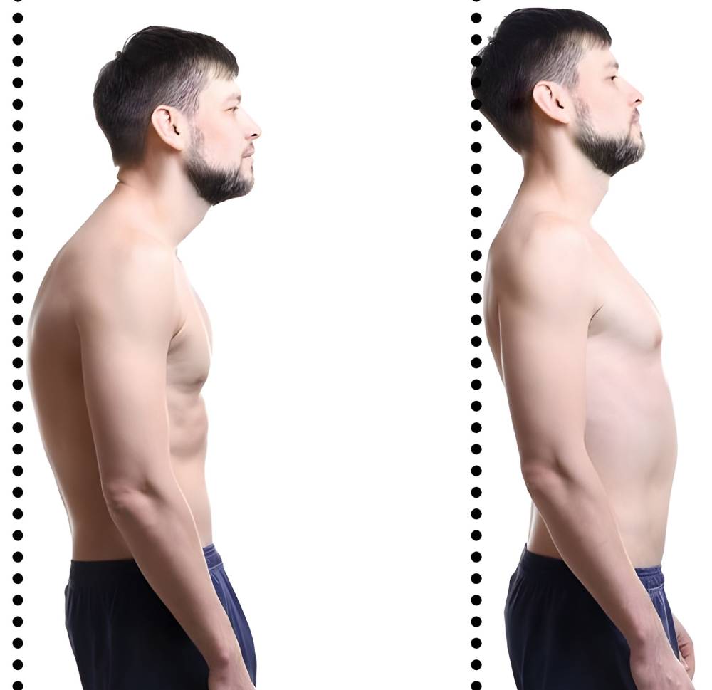 منظور از افتادگی شانه چیست