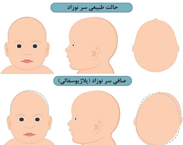 صافی سر نوزاد یا پلاژیوسفالی