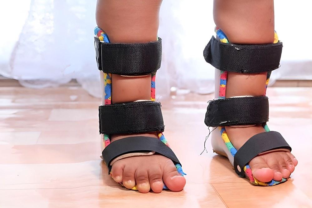 درمان کوتاهی تاندون آشیل با اسپیلنت AFO 