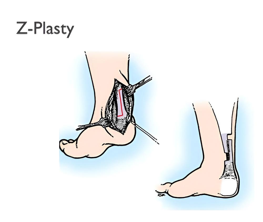 درمان کوتاهی تاندون آشیل با با جراحی Z-plasty
