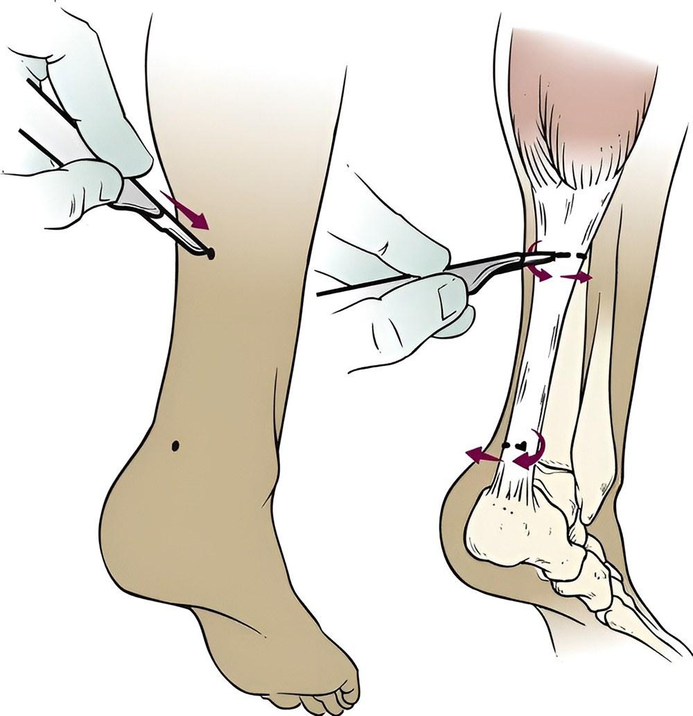 درمان کوتاهی تاندون آشیل با جراحی زیرپوستی