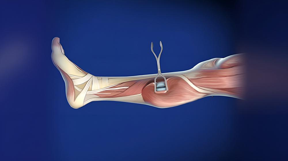 درمان کوتاهی تاندون آشیل با جراحی تحلیل عضله دوقلو
