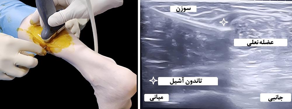 شاک ویو تراپی 