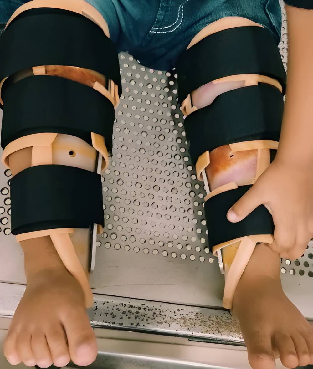 درمان ناهنجاریهای اسکلتی با بریس