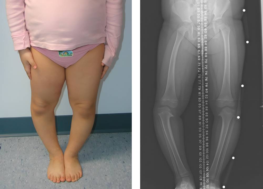 تشخیص نرمی استخوان