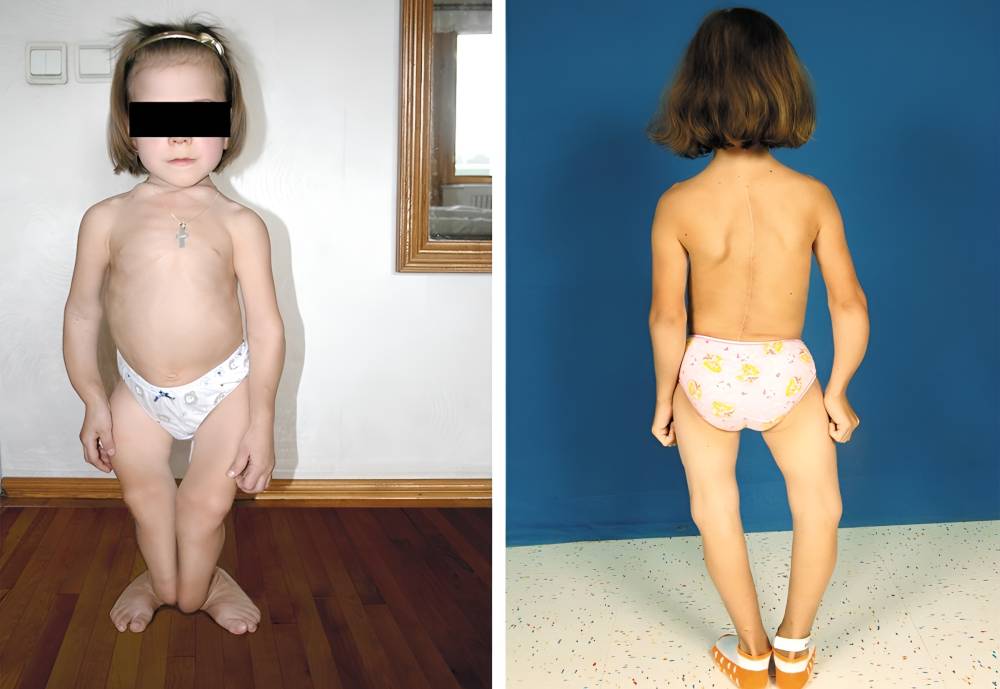 عوارض عدم درمان نرمی استخوان