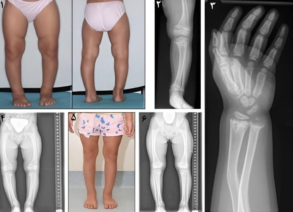 علائم نرمی استخوان