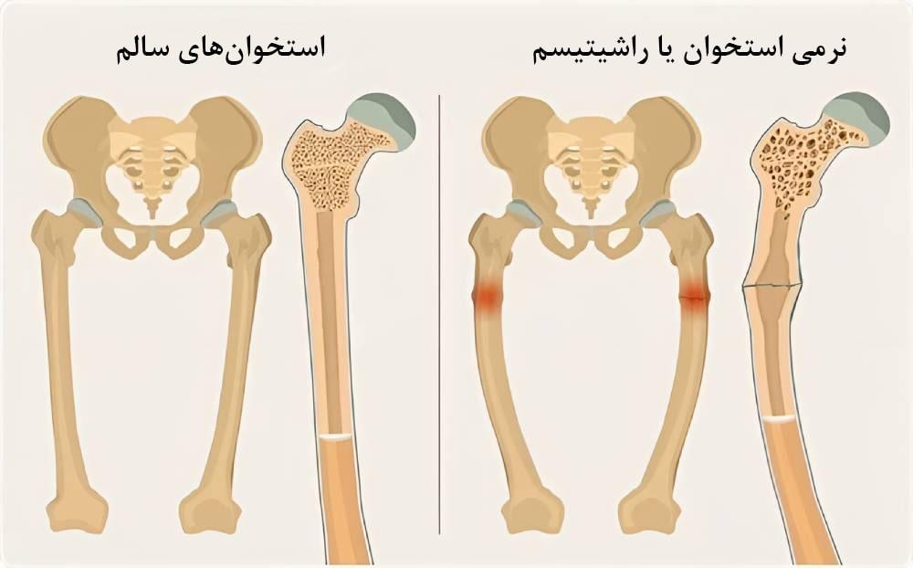 نرمی استخوان یا راشیتیسم چیست؟