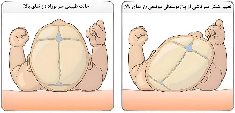 پلاژیوسفالی یا صافی سر نوزاد چیست؟