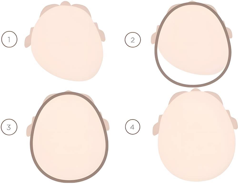 روند اصلاح شکل سر نوزاد با استفاده از کلاه