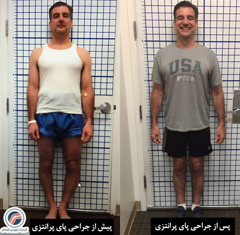 عمل جراحی پای پرانتزی