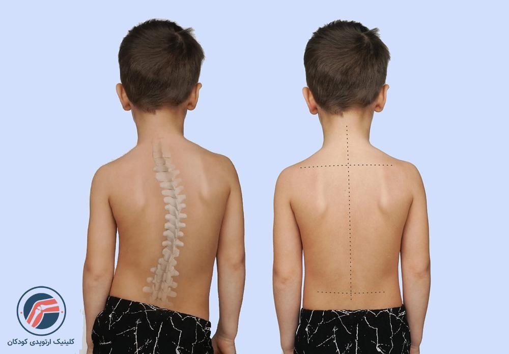 اسکولیوز چیست