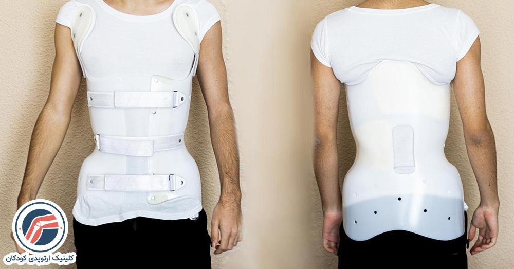 استفاده از بریس پس از جراحی اسکولیوز