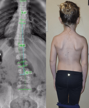 اسکولیوز خفیف