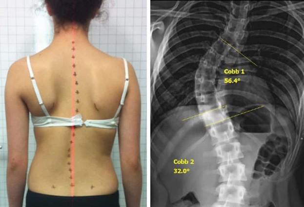عکس اسکولیوز شدید
