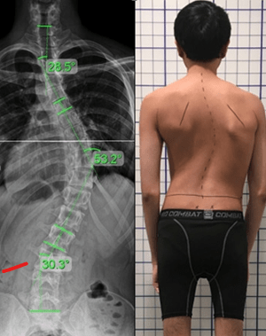 عکس اسکولیوز شدید