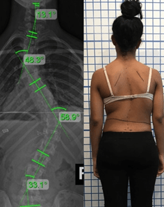 عکس اسکولیوز شدید