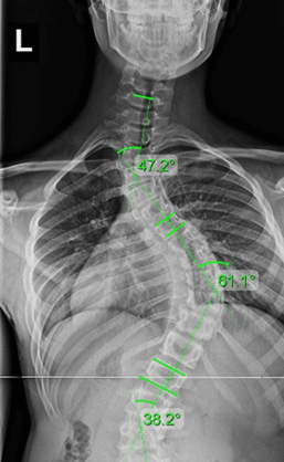 عکس اسکولیوز شدید