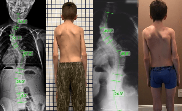 عکس اسکولیوز متوسط