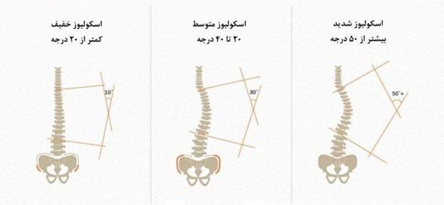 عکس درجه و شدت اسکولیوز