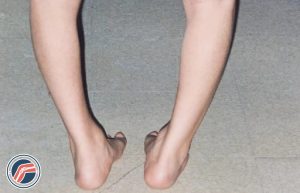 پای پرانتزی شدید