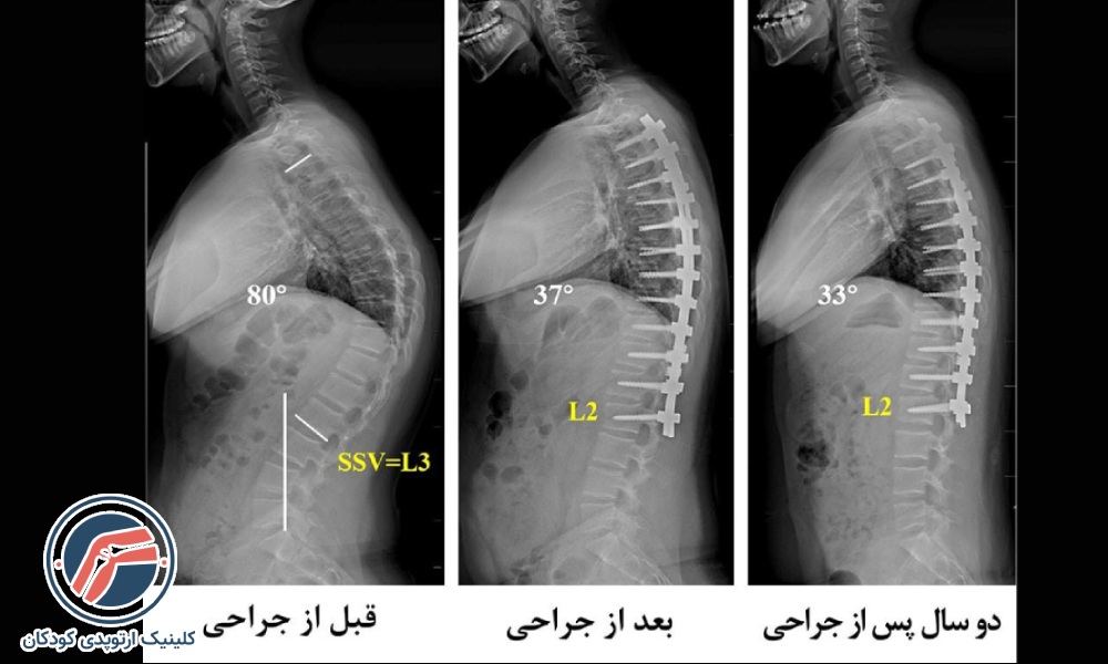 جراحی کیفوز