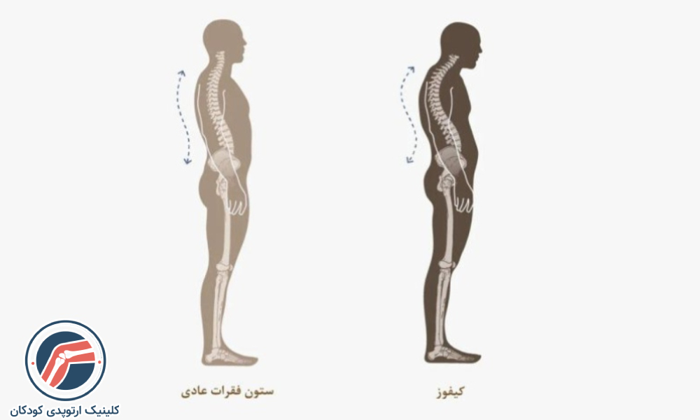 قوز کمر یا کیفوز چیست