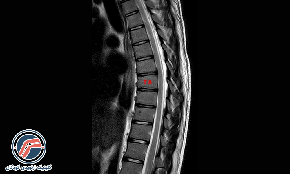 کیفوز خفیف (کمتر از ۵۵ درجه)