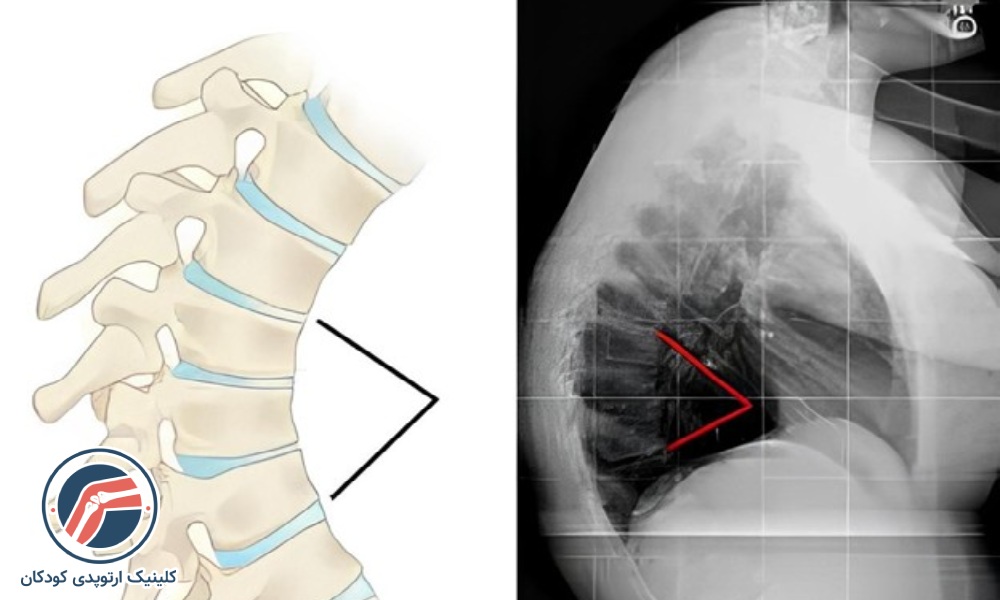 کیفوز شدید (بیش از ۷۵ درجه)