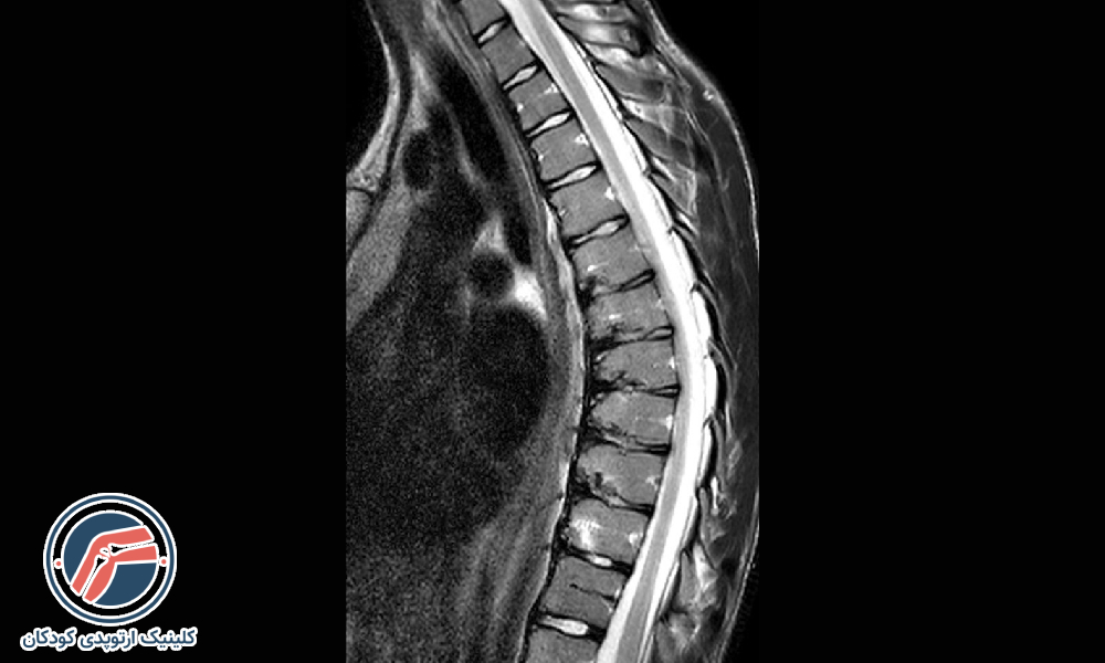 کیفوز متوسط (۵۵ تا ۷۵ درجه)